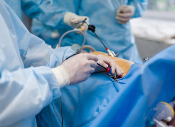 Лапароскопия